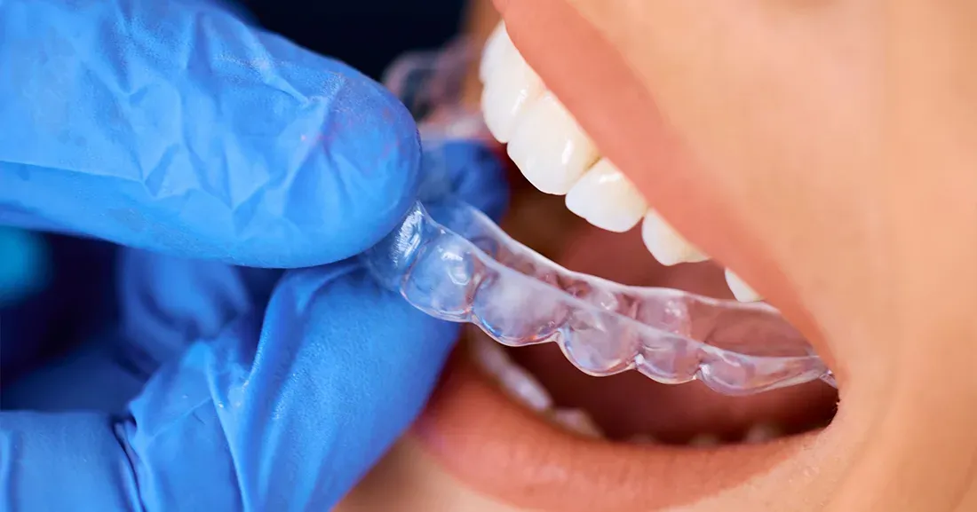Ortodonzia invisibile: efficacia, vantaggi e dubbi frequenti
