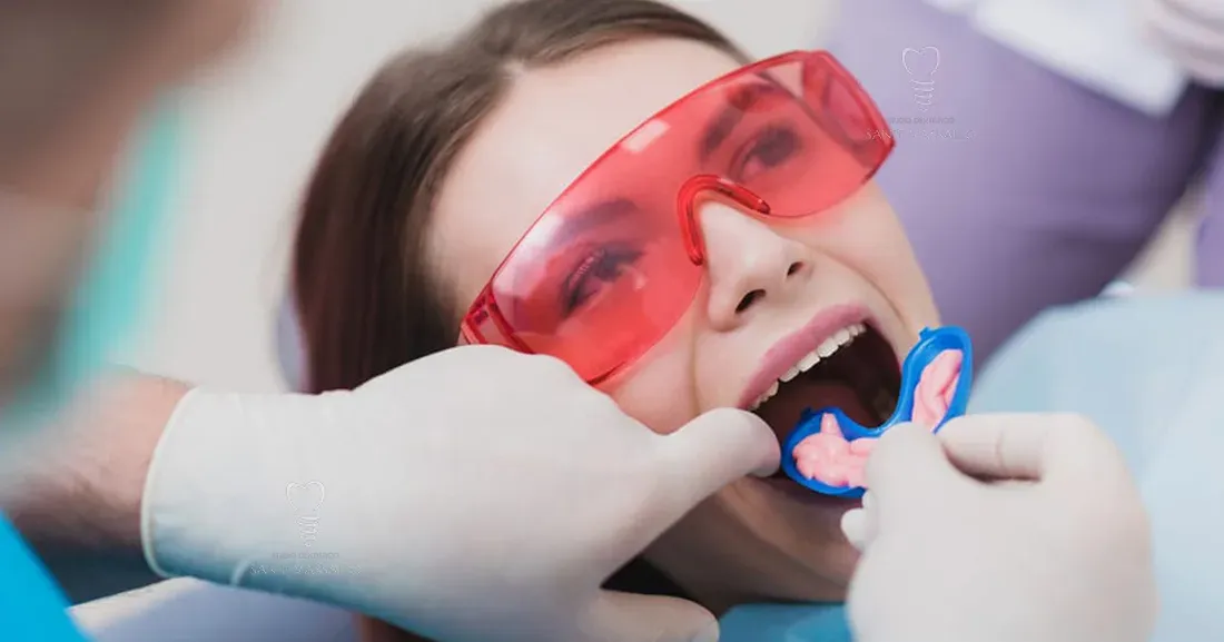 Fluoro e denti: come prevenire la carie con la fluoroprofilassi