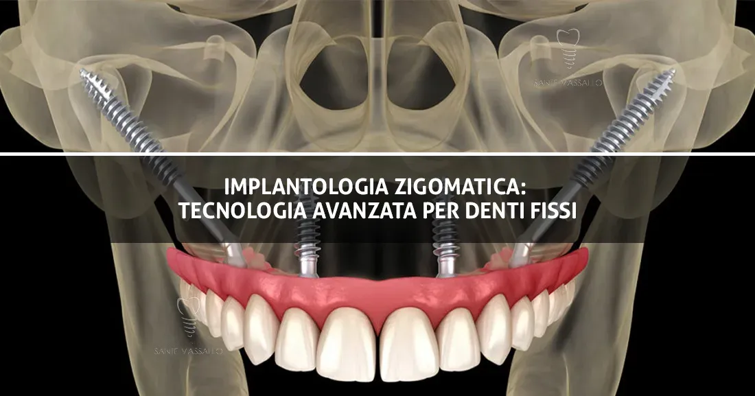 Copertina-Blog Implantologia zigomatica: tecnologia avanzata per denti fissi