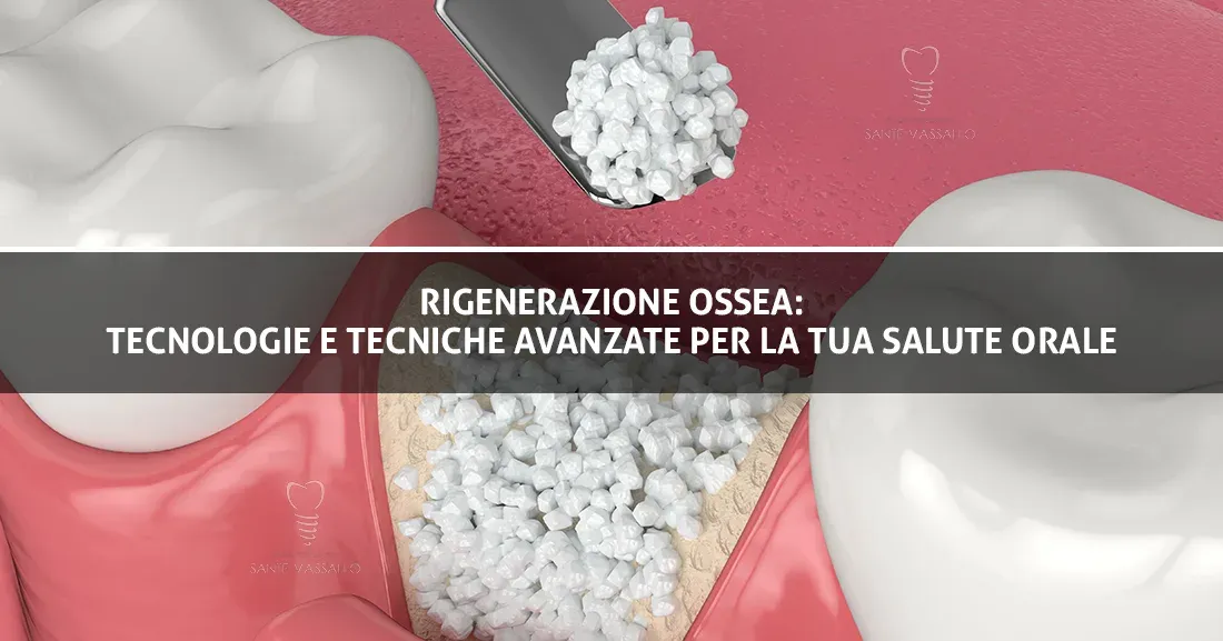 Rigenerazione ossea tecnologie e tecniche avanzate per la tua salute orale - Copertina Blog - Studio Dentistico Sante Vassallo