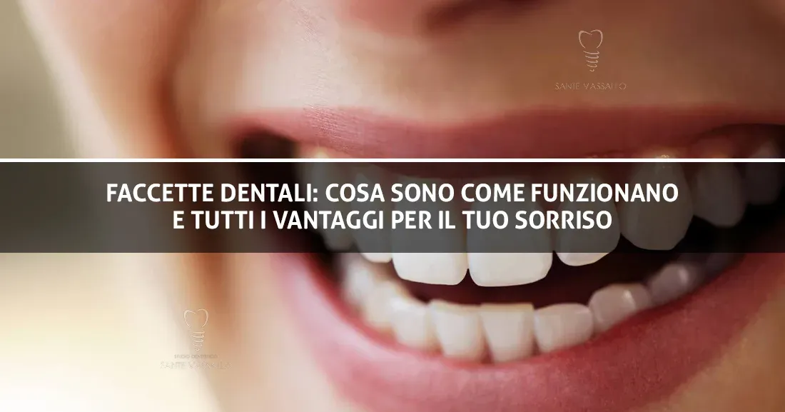 Faccette dentali: cosa sono, come funzionano e tutti i vantaggi per il tuo sorriso