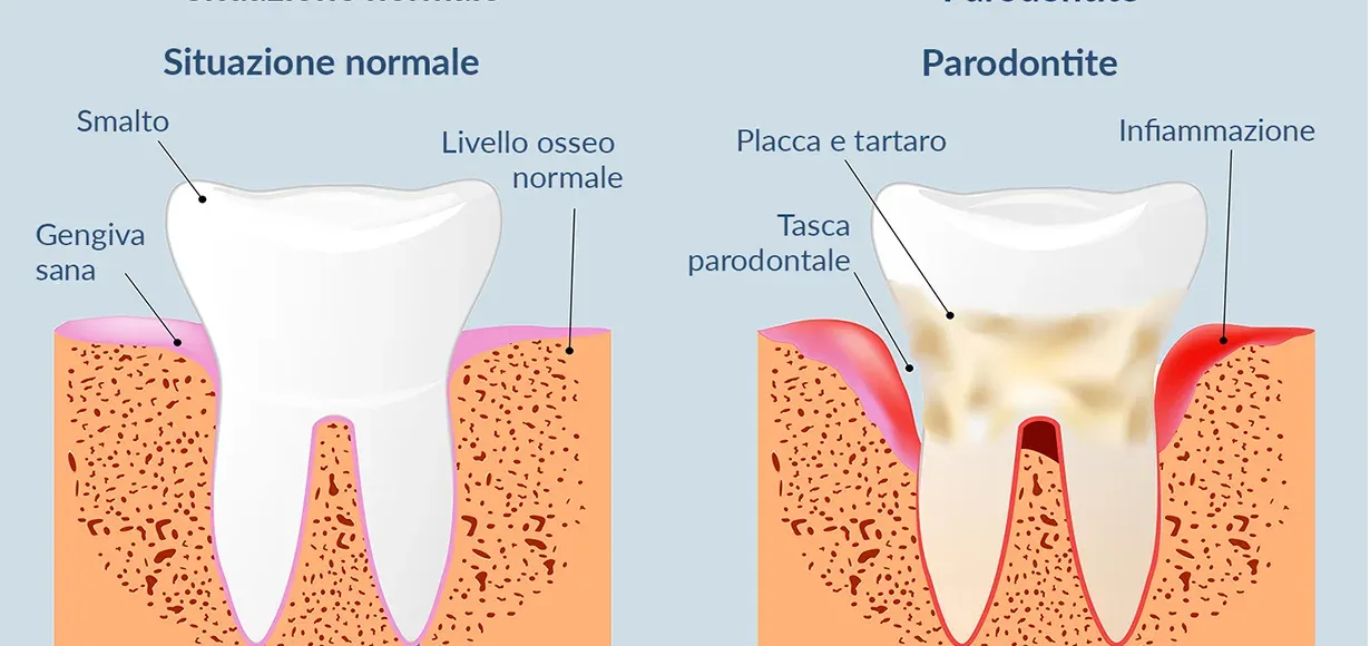 Parodontite: sintomi, cura e prevenzione