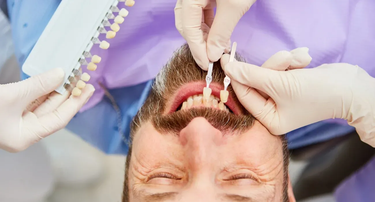 Faccette dentali