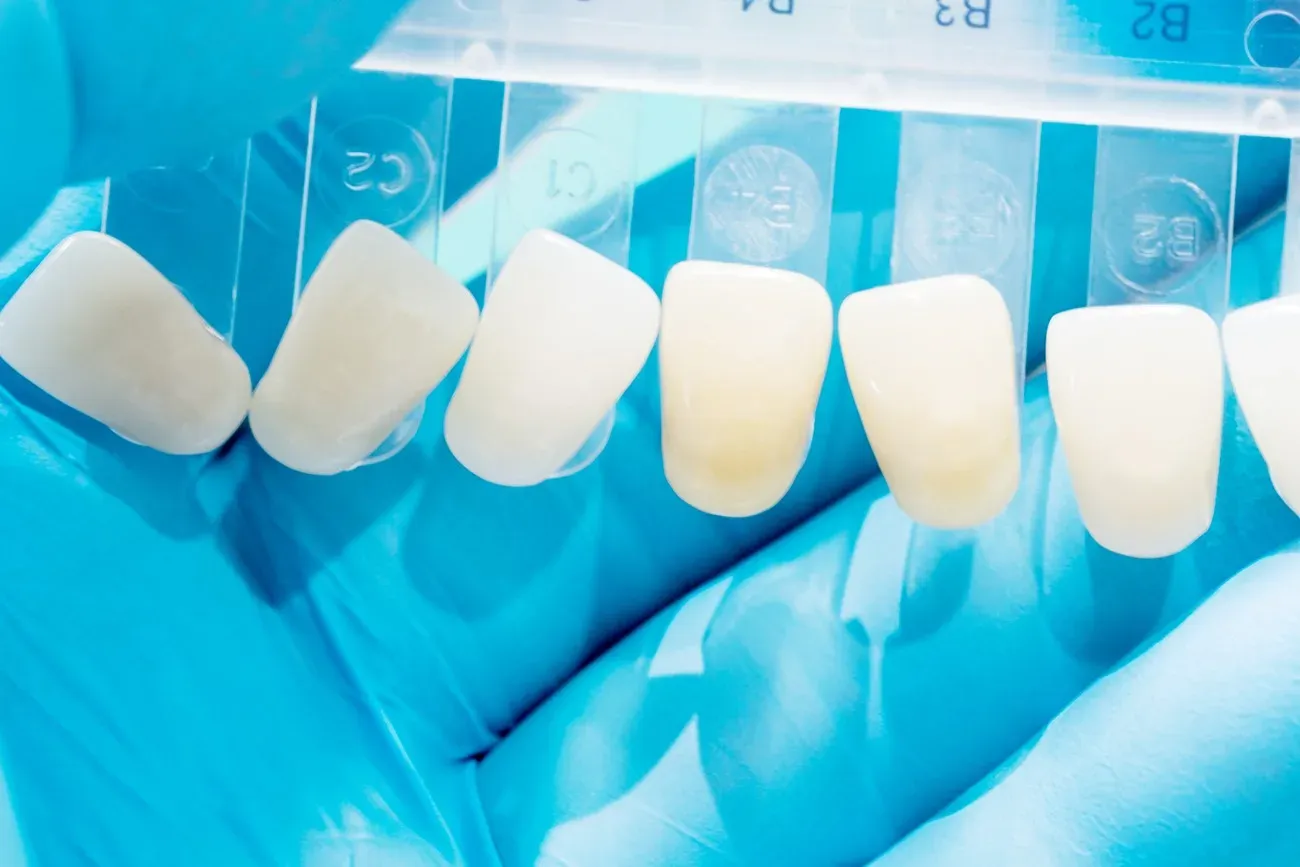 faccette-dentali-in-composito