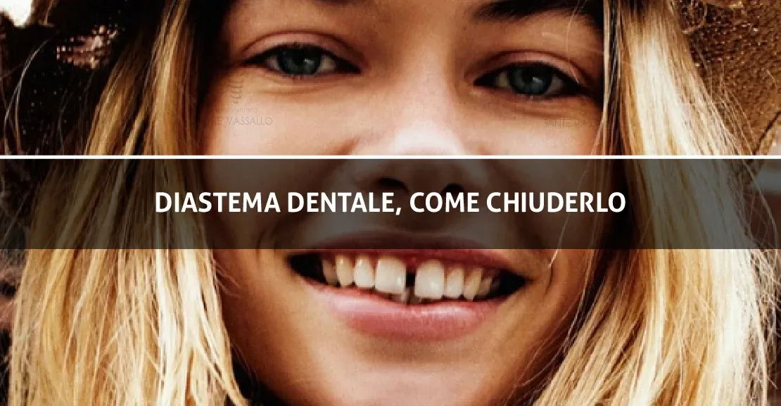 Diastema dentale, come chiuderlo