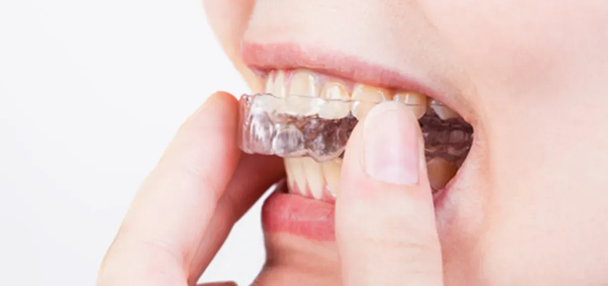 5 benefici del bite dentale