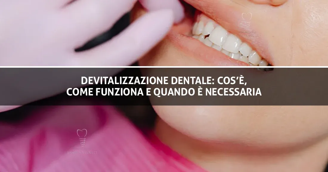 Devitalizzazione dentale: cos’è, come funziona e quando è necessaria