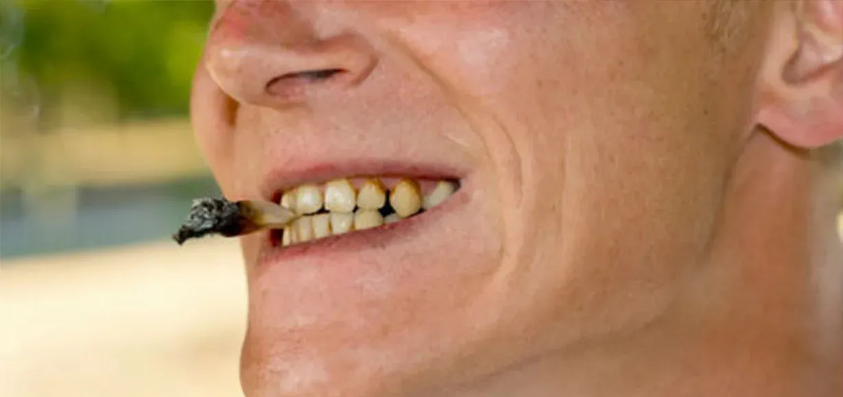 I denti gialli – igiene orale e fumo