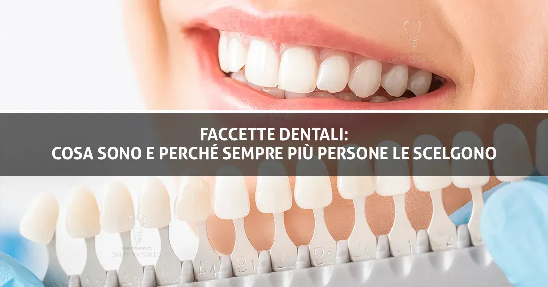Faccette dentali: cosa sono e perché sempre più persone le scelgono