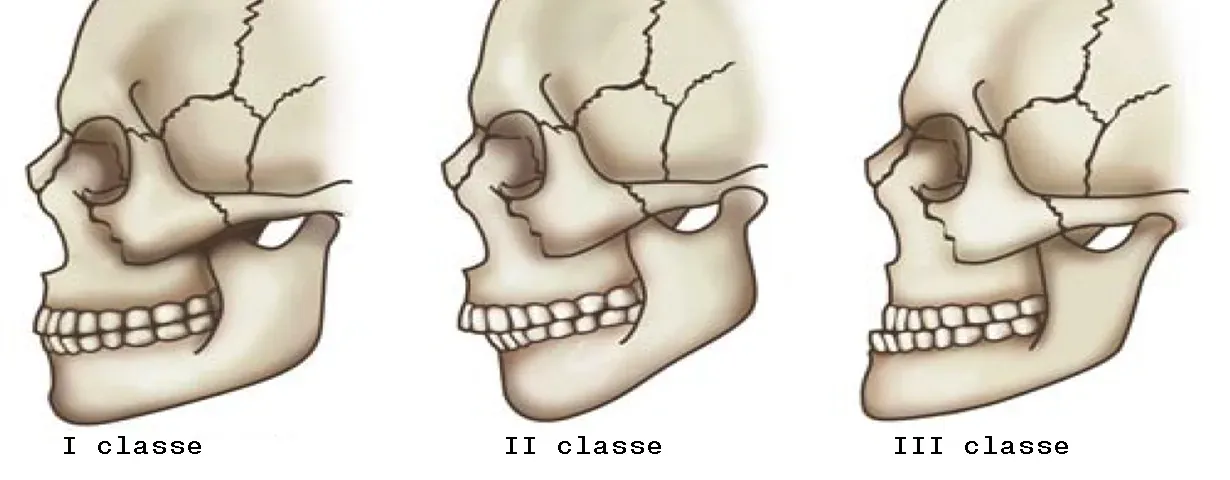 Malocclusione- cause e trattamenti