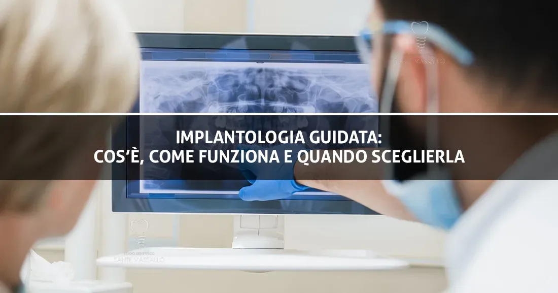 Implantologia guidata: cos’è, come funziona e quando sceglierla