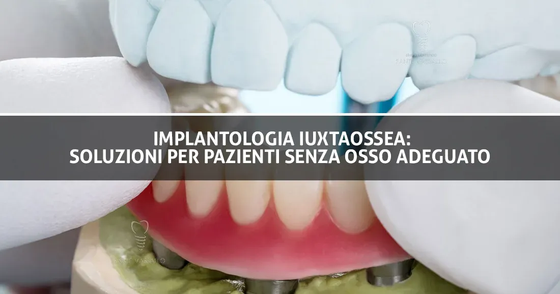 Implantologia iuxtaossea: soluzioni per pazienti senza osso adeguato