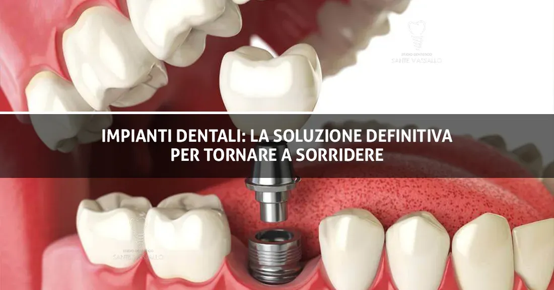 Copertina Sante - Impianti Dentali