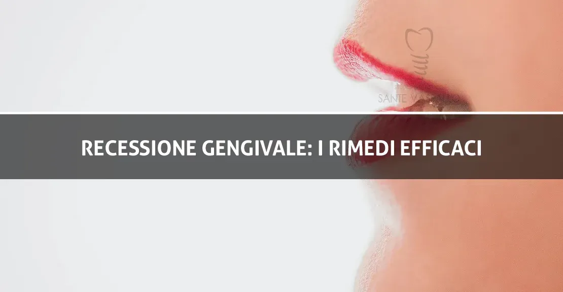 Recessione gengivale