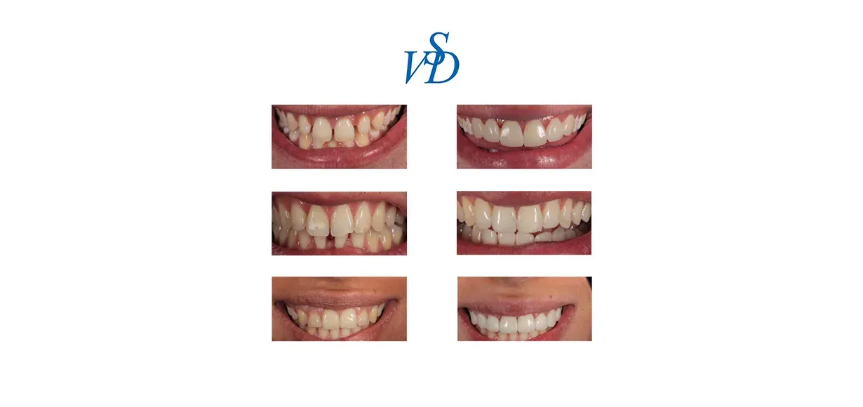 Le faccette dentali – un nuovo sorriso a portata di denti