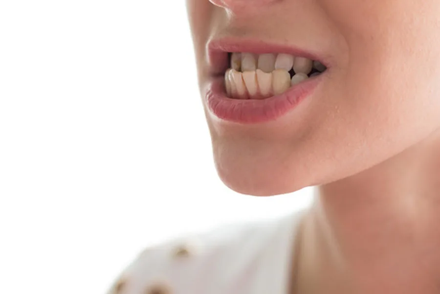 Denti erosi
