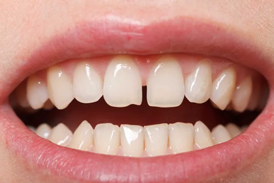 diastema